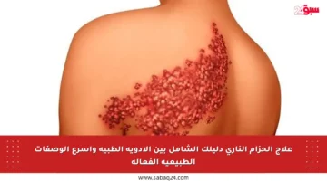علاج الحزام الناري دليلك الشامل بين الأدوية الطبية وأسرع الوصفات الطبيعية الفعالة
